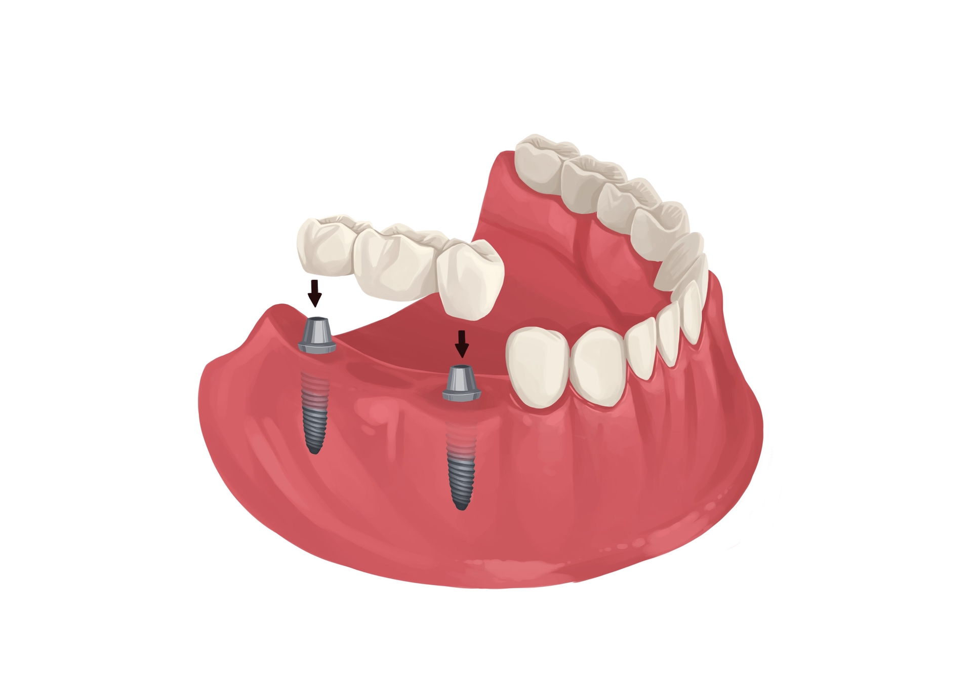Does Medicaid Pay For Dentures In Louisiana Does Medicaid pay for dental implants? | Authority Dental