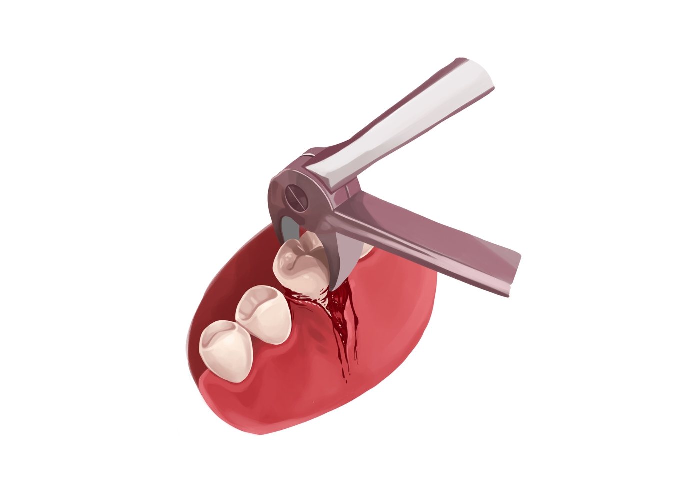 What are the do’s and don’ts after tooth extraction? | Authority Dental