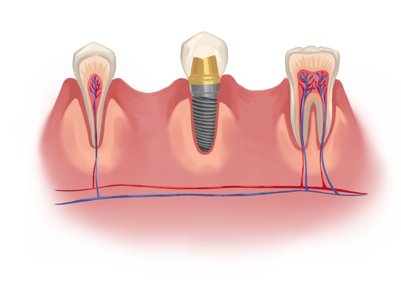 Dental implant vs. natural tooth with nerves