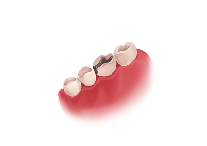 Amalgam dental filling