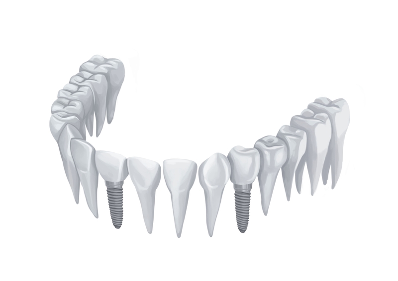 Dental implants on lower arch without gums